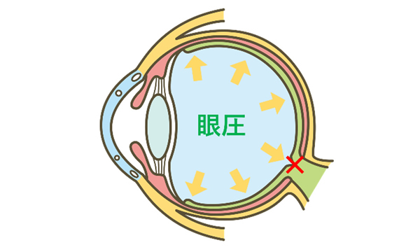 熊本ステーション眼科 緑内障 眼圧